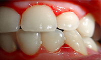 dentadura con gingivitis