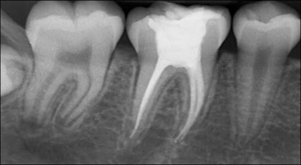 radiografia de una endodoncia